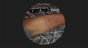 DeonGarth's tweet photo. Not many are going to have time nor bother reading this Tweet but want to type out that I'm 15 months clean from self-harm since Nov. 10. @ 10:10pm.. 

Sorry for the blurry image but that's an example of my scars i had a few years ago.

https://t.co/2gmSfXeRTD - My YT Channel ^-^ https://t.co/AKCQKmXxU8