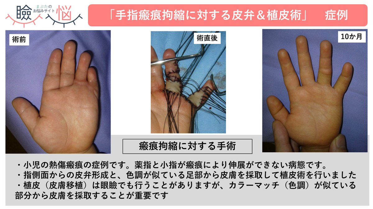 巻き爪 と まぶた(眼形成外科)の専門医 ＠ 形成外科医 on X: 