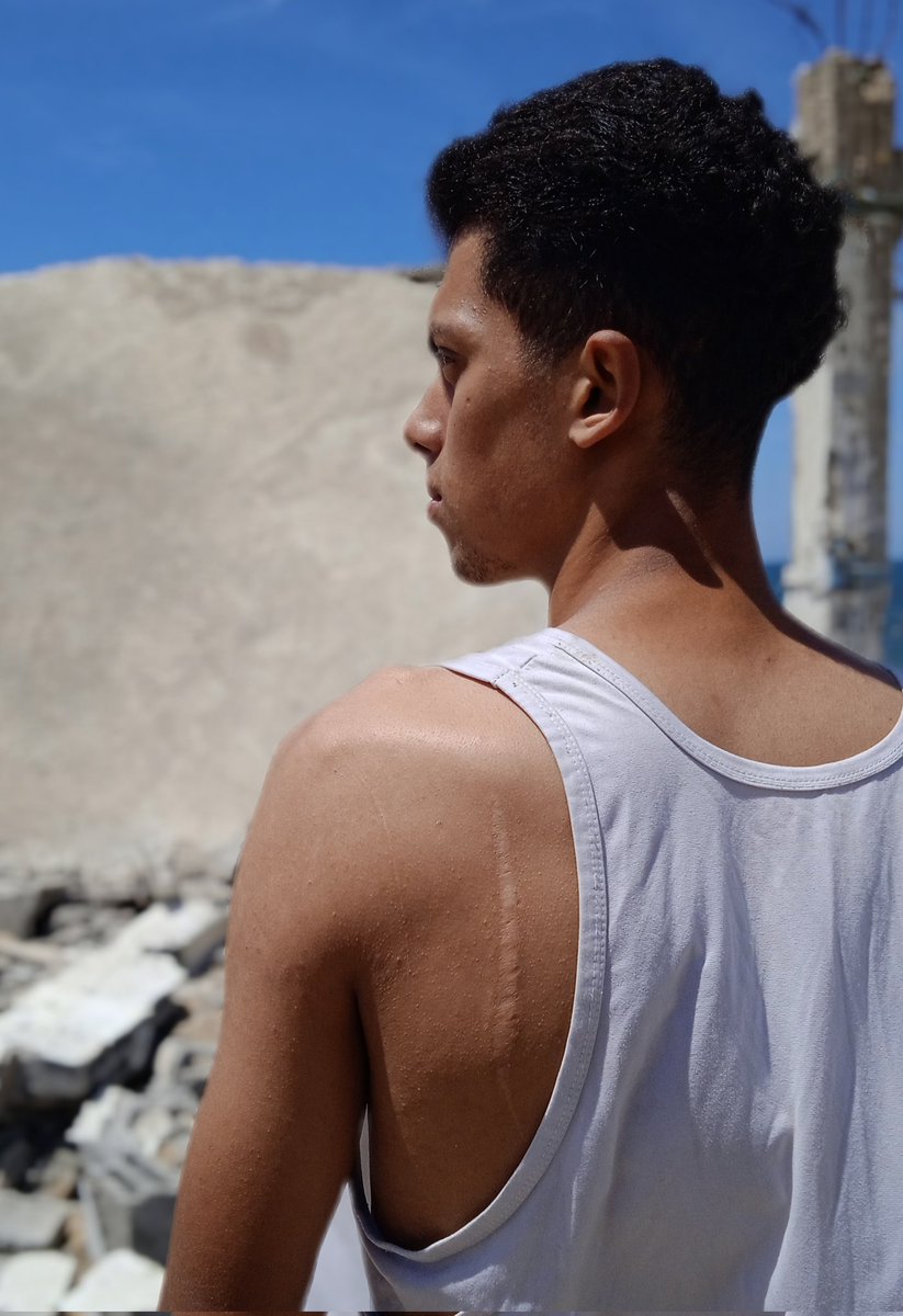 mohamadhas57977's tweet image. The effects of war on our bodies do not end with the end of the shooting. The war almost ended, but the suffering still exists chuffed.org/project/134400…