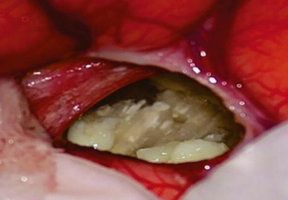 🥴A 17-year-old male presented with a 4-year history of episodic generalized seizures and progressive headache. Three weeks before admission, he developed quadriparesis, urinary and fecal incontinence, and behavioral changes.

What’s your diagnosis?