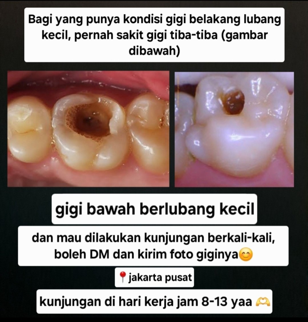 arisuuww's tweet photo. Hii gaiss!!
Bagi yg gigi belakang berlubang kecil, suka sakit tiba2, yg mau dirawat akar, kunjungan berkali2, boleh banget dm ya! Gratiss
Kunjungannya hari kerjaa jam 8-13 yaps🤗
📍 domisili :  jakarta pusat
#sakitgigi 
#perawatansaluranakar #perawatangigigratis #koasgigijakarta https://t.co/zyshrAt5MV