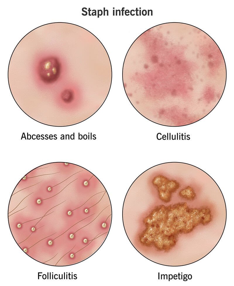 CHIMA3V's tweet photo. Does Islam have staph??? https://t.co/j1DsNSmcgV