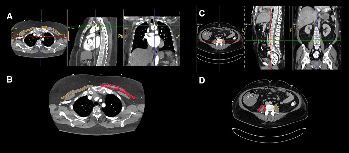 asaiojournal's tweet image. From Imaging to Insight: Sarcopenia as a Marker of Venoarterial Extracorporeal Membrane Oxygenation Mortality in Postcardiotomy Shock
ASAIO Journal 71(11):p 897-904, November 2025. | DOI: 10.1097/MAT.0000000000002426
ow.ly/Fo6J50XpeZA
#ASAIO