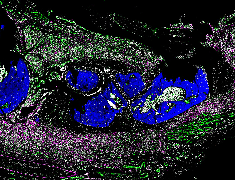 SciImmunology's tweet image. A new Science #Immunology study demonstrates that T helper 17 (#TH17) cells upregulate CD44 and S1PR4 to transform into disease-promoting exTH17 cells in the synovium, which matches findings from human patients with #RheumatoidArthritis. scim.ag/3LsoX7B
