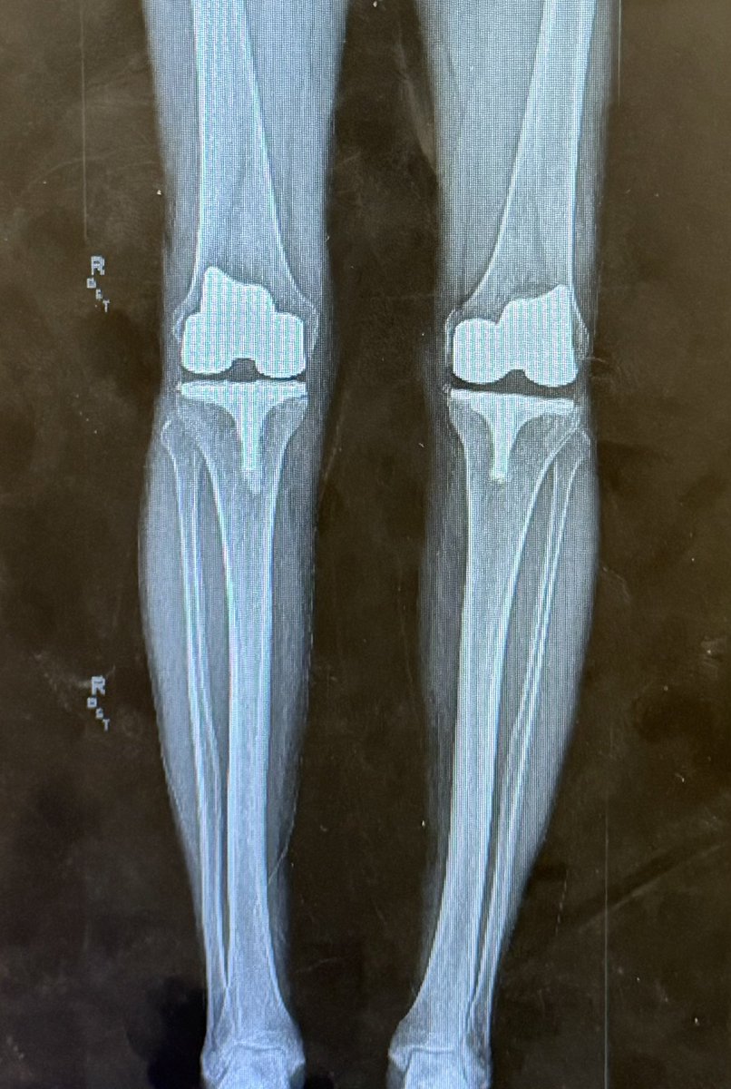 BigErn23's tweet photo. @ksorbs Went through this on June 30th this year. I now have a matching set of knees after having the left done in 2020. https://t.co/rPgZF82Th7