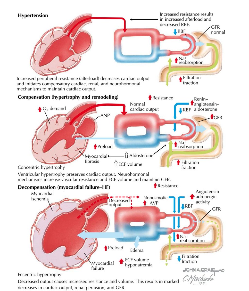 TrackYourHeart's tweet photo. Hypertension to Heart Failure: https://t.co/JpKQJ6VyrO