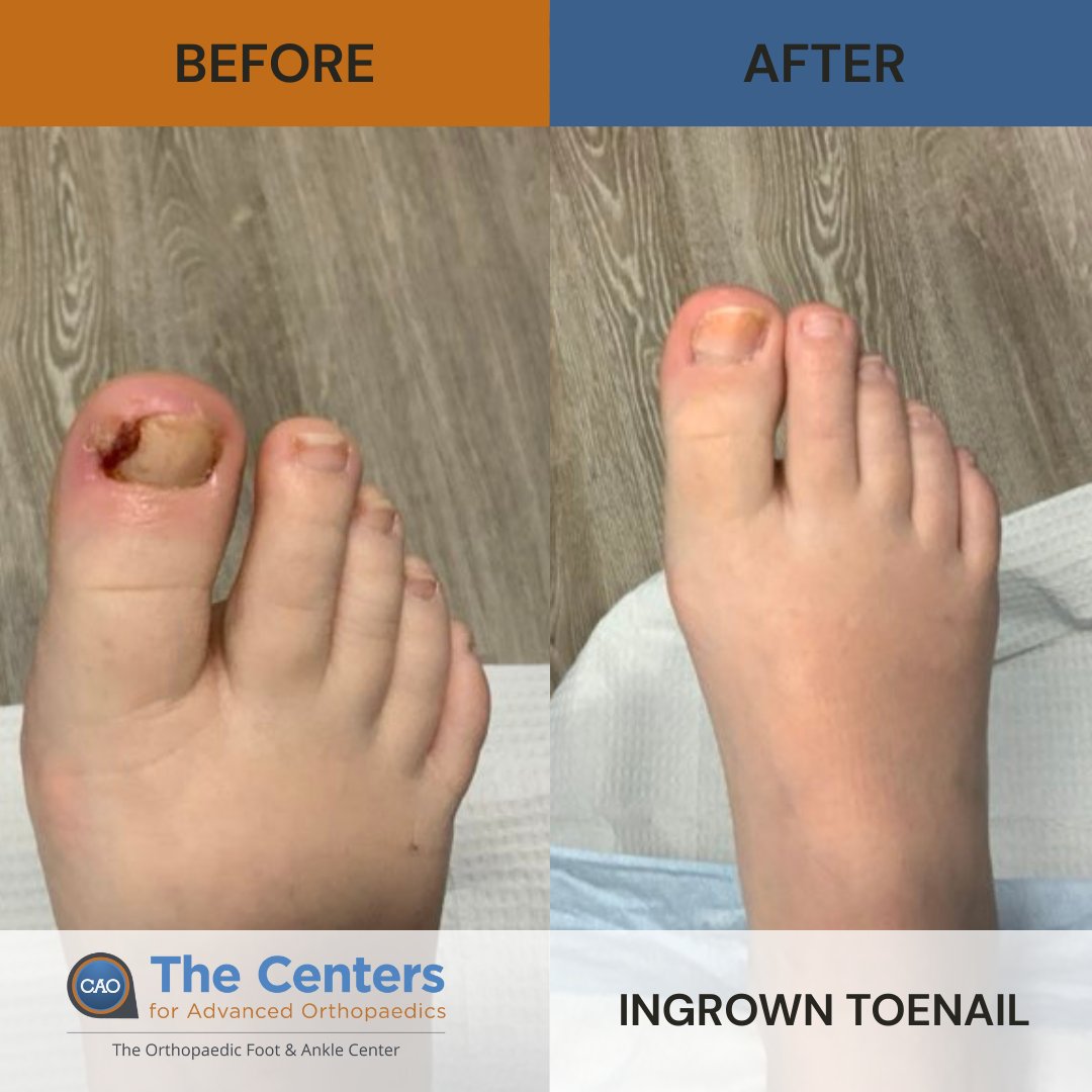 Footankledc's tweet image. This before-and-after reflects the successful correction of an ingrown toenail by Dr. Arthur Black. Through advanced care, patients can return to pain-free movement and improved foot health. 👣

#Podiatry #Orthopedics #FootHealth #IngrownToeNail #Healing #ExpertCare #PatientCare