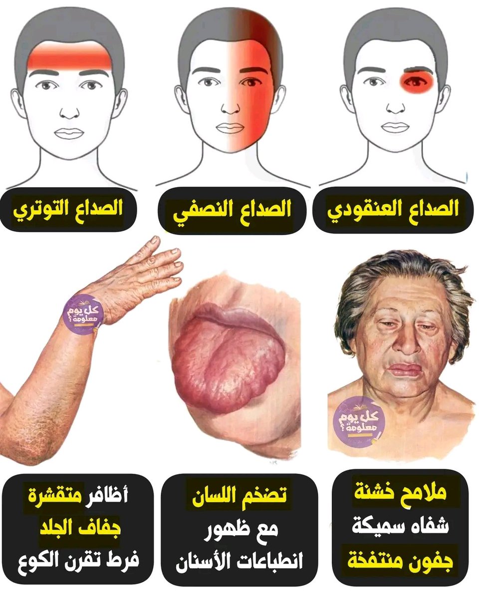 ✅️ الصداع العنقدي : التدخين، شرب الكحول، التعرض لدرجات الحرارة عالية
✅️ الصداع النصفـــي : بسبب اضطرابات في الأعصـــاب والأوعية الدموية 
✅️ الصداع التوتري : بسبب توتر عضلات الرقبة أو الظهر 
✅️ ملاح خشنة، شفاه سميكة، جفون منتفخة : بسبب مسببات الحساسية، الإلتهاب 
✅️ تضخم