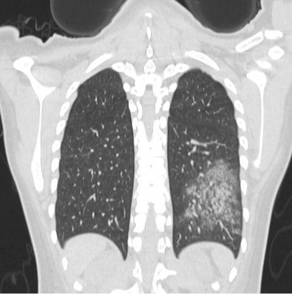 neph_ag's tweet photo. Although she had no respiratory symptoms, lung CT scan showed images compatible with alveolar hemorrhage.

Finally, the p-ANCA test result was positive. https://t.co/kmSZ6NItWD