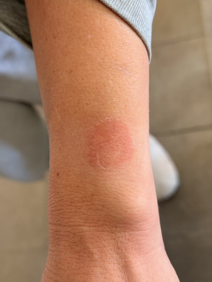 Close-up photograph of a person's left wrist showing a circular red rash or burn mark approximately 2-3 cm in diameter on the inner side, with slightly raised and shiny skin; the wrist is extended with a gray sleeve visible, and a white surface in the background.