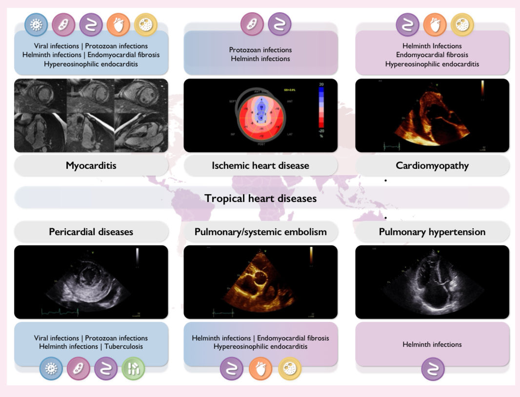 Ed_Alania's tweet image. 🗺️ Cardiac imaging in patients with tropical diseases: a scientific statement @ESC_Journals #Cardiology #CardioEd #echofirst #FOAMed