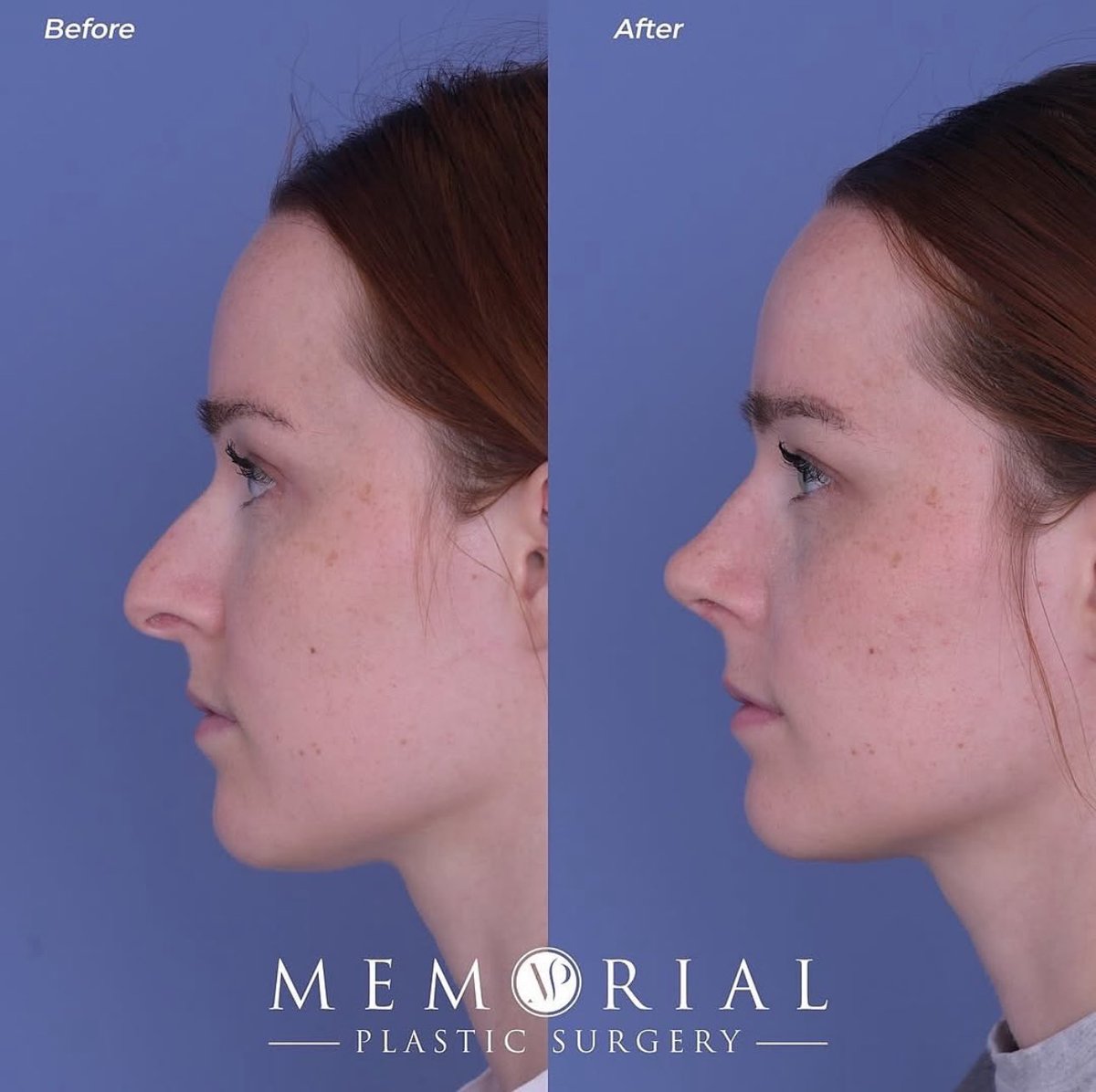 MPS_Surgeons's tweet photo. 1 month post-op from a Rhinoplasty + Septoplasty by Dr. McElwee 🔥🙌

#beforeandafter #nosejob #newnose #facialplasticsurgery #MPSFace https://t.co/9WcJ6jvj4I