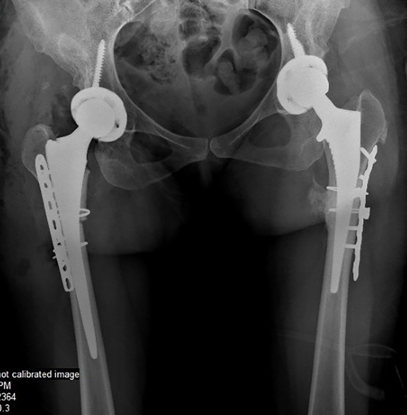 This multicenter study reinforces that realistic outcomes can be achieved using different surgical techniques and a range of implant types in Crowe IV DDH. 

arthroplastyjournal.org/article/S0883-…