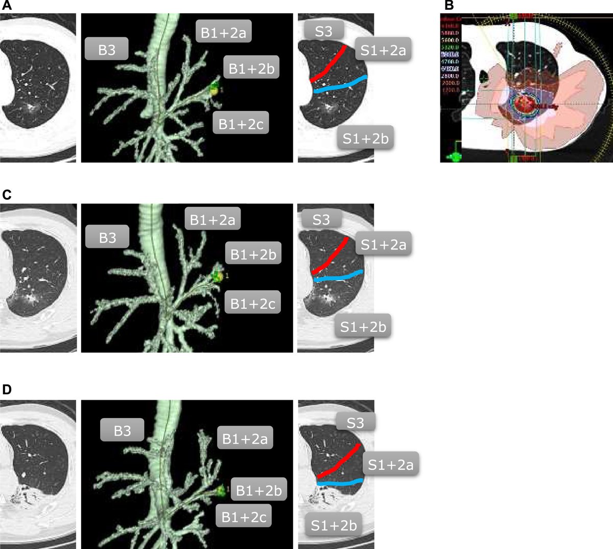 ASTRO_org's tweet image. #New in practicalRO: Segment-Targeted Precision Ablative Radiotherapy with Exact Delivery (SPARE): A Novel Anatomically-Guided SBRT Technique. #radonc tinyurl.com/proneri1