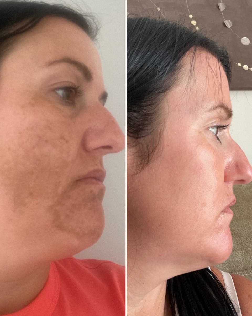 🗣️ Name: Amie 
❤️ Skin concern: Melasma 
🧪 Treatment ingredients: Azelaic acid, Niacinamide
⏰ Treatment length: 11 months