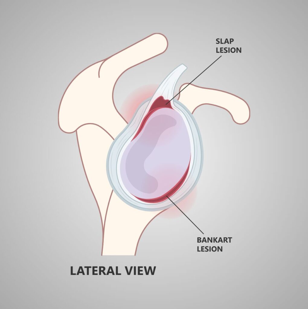MedEd_Cases's tweet photo. The Forced Shoulder Abduction and Elbow Flexion Test evaluates for SLAP tears of the shoulder. The examiner brings the patient’s shoulder into maximal abduction, then flexes the elbow so the hand moves down behind the head toward the opposite shoulder. A positive test is indicated by pain at the posterosuperior aspect of the shoulder during forced maximal abduction, which is relieved or diminished when the elbow is flexed. Sensitivity and specificity is 67%!

Read: https://t.co/3loOwdI0Ll

Watch: https://t.co/mvyCHiqdjv

#SportsMedicine #Orthopedics #PhysicalTherapy #AthleticTraining #Rehab #InjuryPrevention #Physio #SportsInjury #SportsRehab #PhysioTherapy #Meded #FOAMed