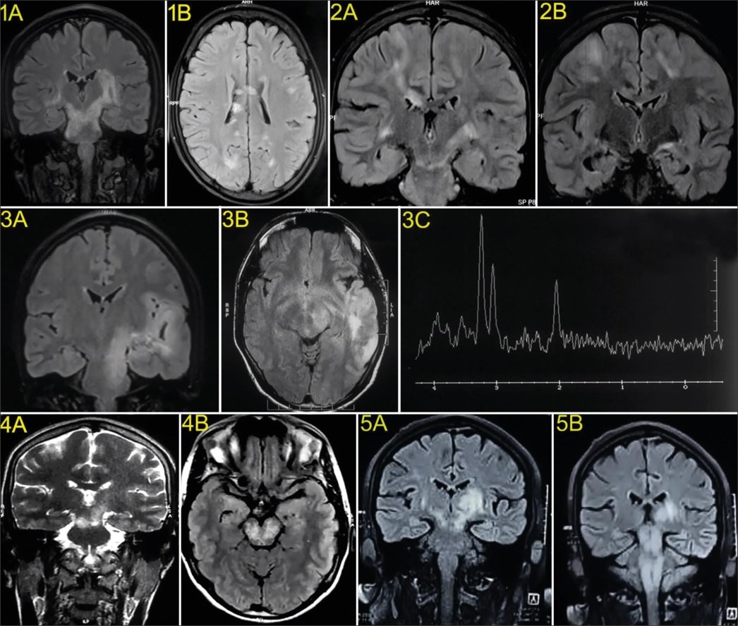 The "cascade" (waterfall) sign on coronal images on MRI can be see with multiple sclerosis (image 1), myelin oligodendrocyte glycoprotein associated disease (image 2), glioma (image 3), and behcet's disease (image 5) journals.lww.com/neur/fulltext/…
