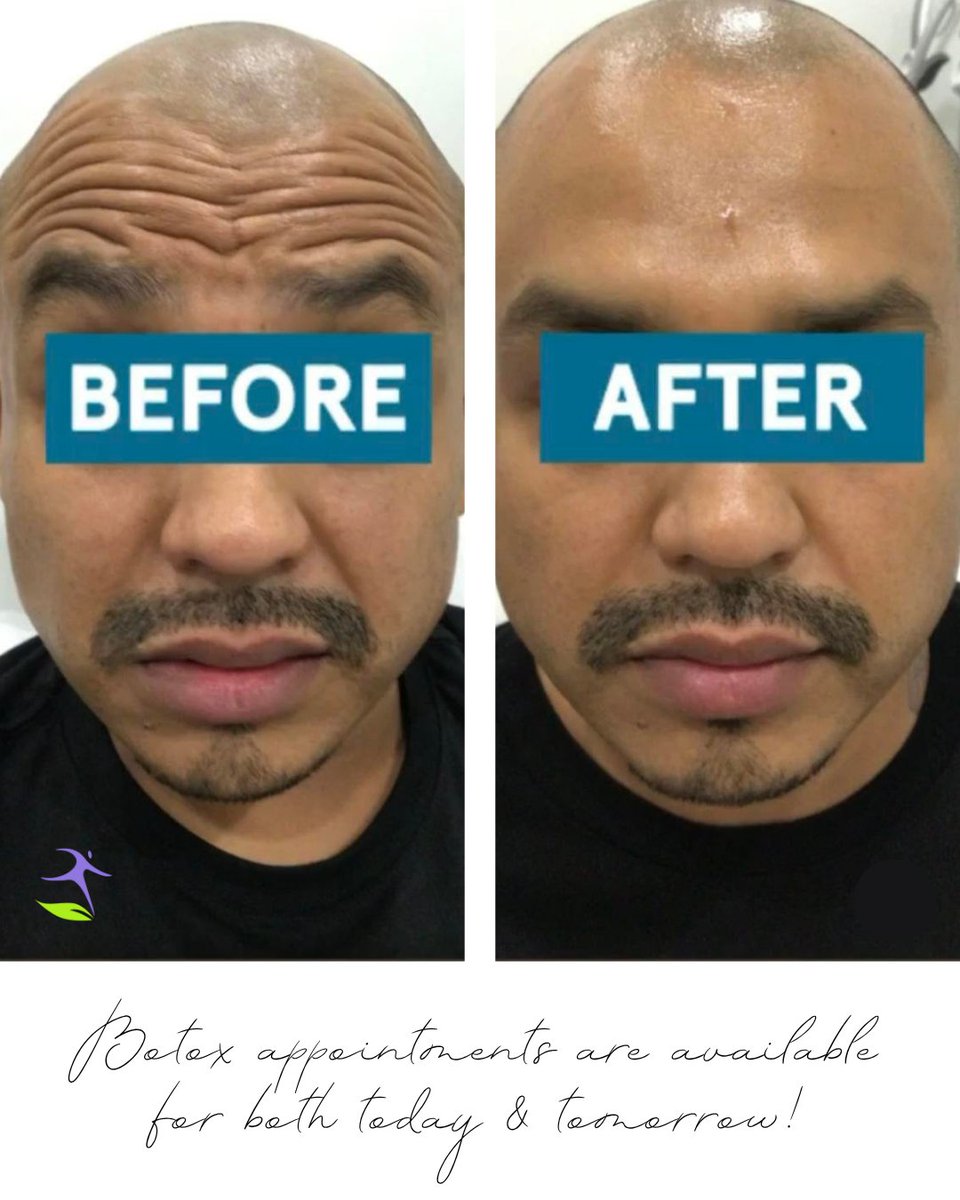 MWeightControls's tweet image. Smooth, natural, and refreshed — just the way it should be. 💫
See real Botox results from our patients and experience the same glow for yourself!

✨ Appointments available today and Friday at our Corona location!
Call (951) 273-9800 to book your spot before they’re gone.…