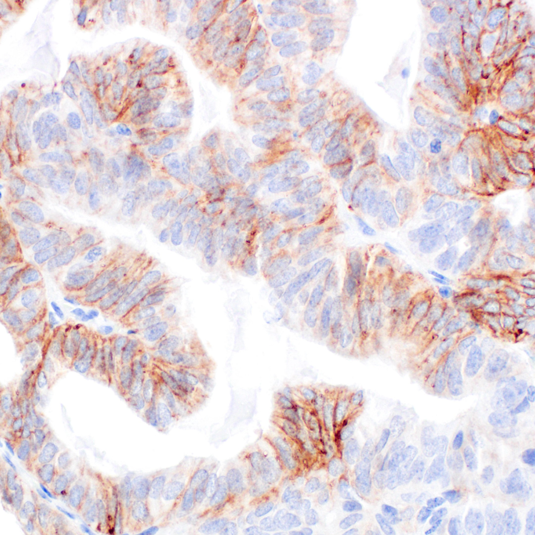 CellSignaling's tweet image. SMaseは、スフィンゴミエリンの加水分解を触媒し、セラミドとホスホコリンを生成します。中性SMaseであるnSMase2は、脳損傷後の細胞外小胞 (EV) の生合成に関連することが示唆されています。#44083 は、ヒト、マウスとラットサンプルのWBとIHC-Pに適しています。hubs.ly/Q03P-ZG10