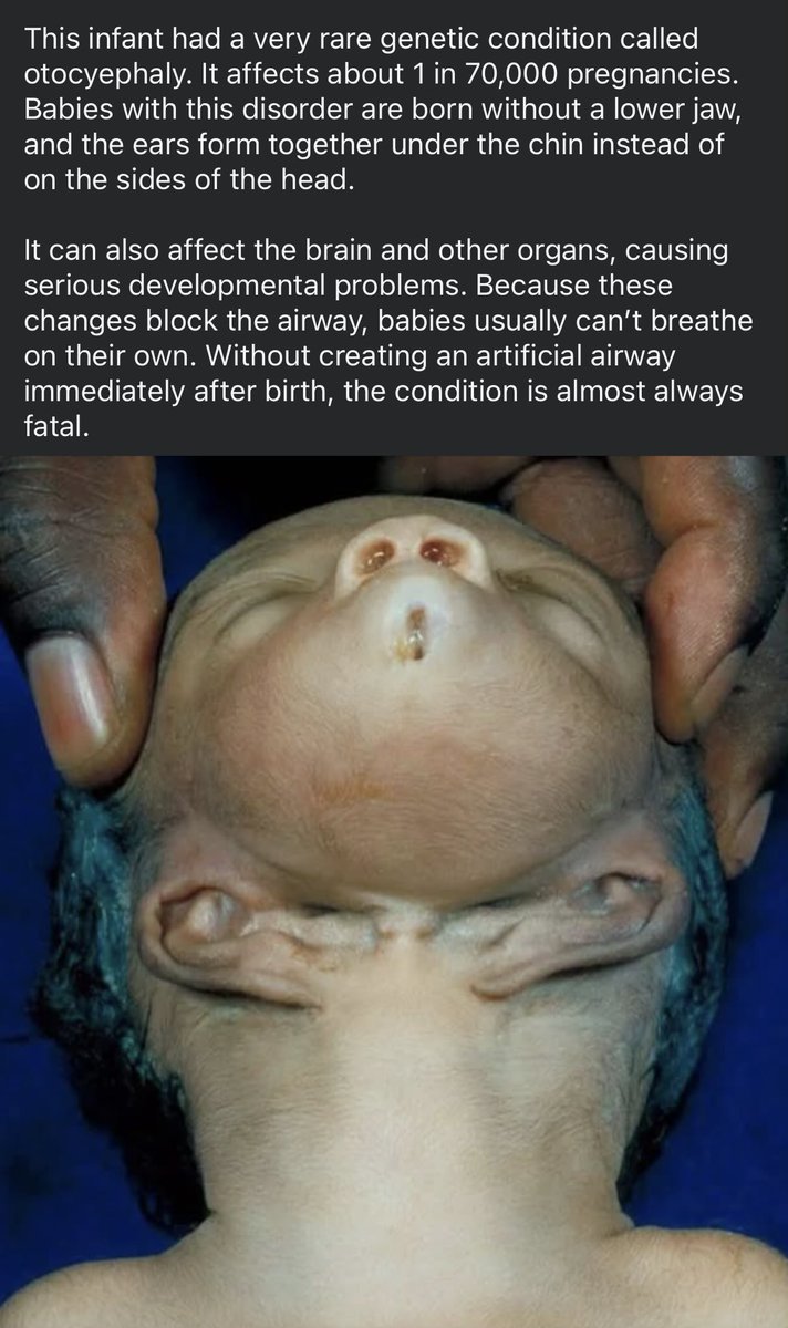 Trigger Warning: sensitive content
I am intrigued by medical mysteries and ran across this condition
I’d never heard of this before