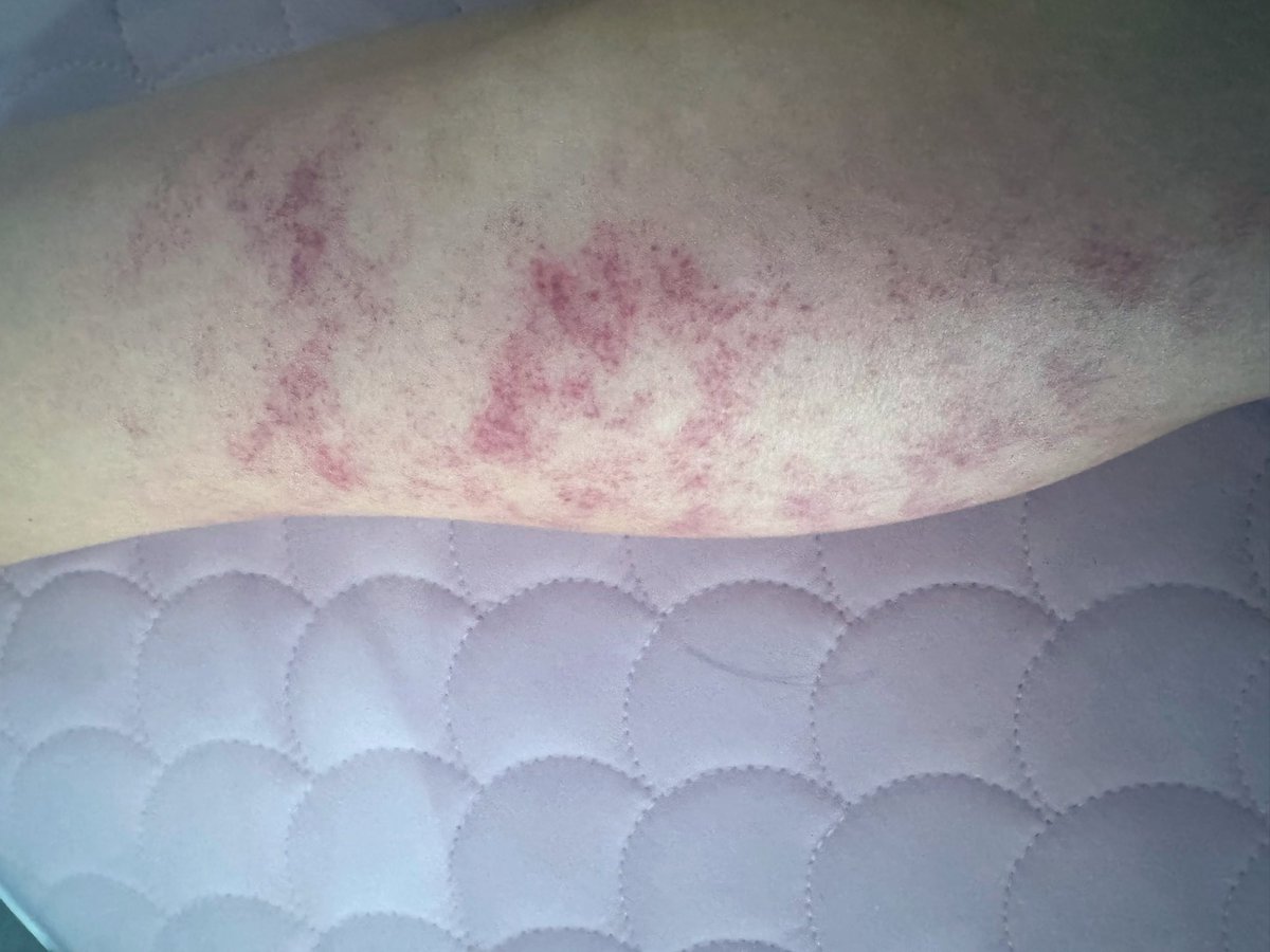 msgm486's tweet image. 마사지 추가 리뉴얼됬어요~~💕

괄사+셕션 

뭉침 결림 셀룰라이트 박살 💥♥️💥♥️

⚠️스웨디시 제외 모든 마사지에 적용됩니다
근막마사지라 피멍드는점 참고하세요🫡

원하지않을시 핫스톤으로 대체됩니다
⚠️핫스톤은 페이스엔 제외됩니다

#구월동미사지
#구월동왁싱
#구월동타투
#인천마사지