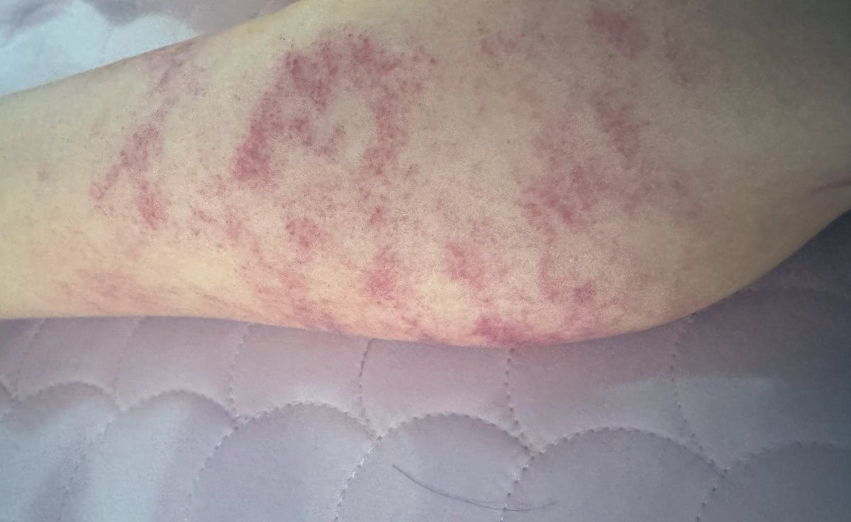 msgm486's tweet image. 마사지 추가 리뉴얼됬어요~~💕

괄사+셕션 

뭉침 결림 셀룰라이트 박살 💥♥️💥♥️

⚠️스웨디시 제외 모든 마사지에 적용됩니다
근막마사지라 피멍드는점 참고하세요🫡

원하지않을시 핫스톤으로 대체됩니다
⚠️핫스톤은 페이스엔 제외됩니다

#구월동미사지
#구월동왁싱
#구월동타투
#인천마사지