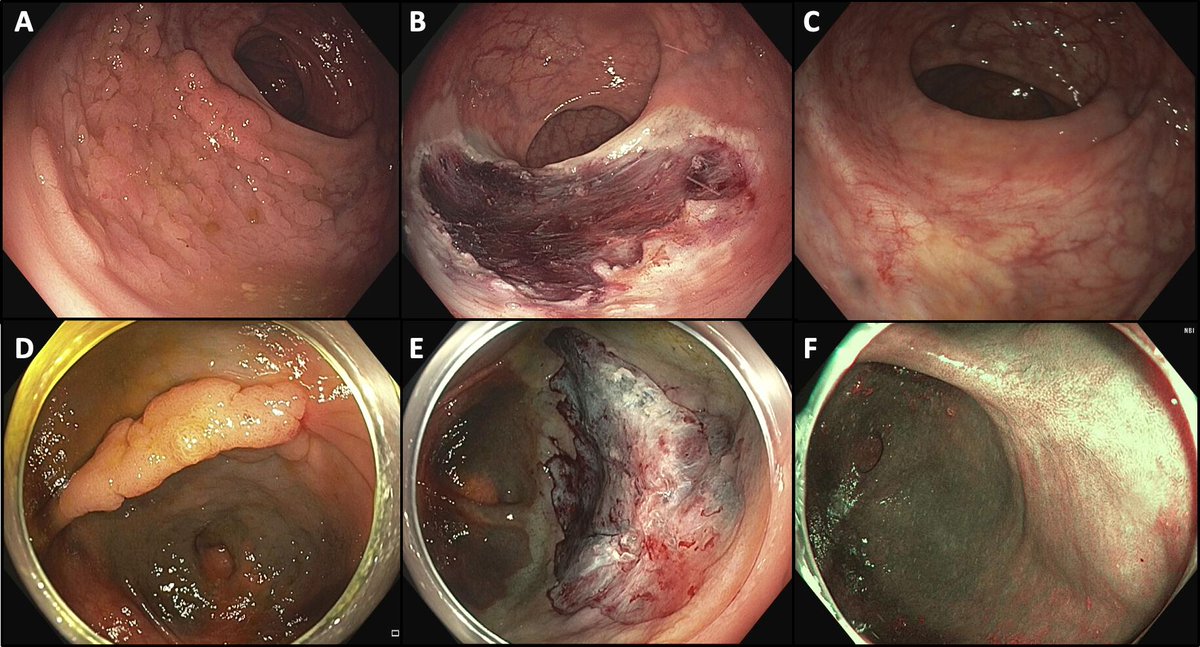Gut_BMJ's tweet photo. #GUTImage from the paper by Pohl et al on
"Cold snare endoscopic resection for large colon polyps: a randomised trial" via
https://t.co/CRox0E1Iq8
@Rex_colonoscopy @ZachSmithGI @CyrusPiraka
#ColonicPolyps #ColdSnare https://t.co/jsH6KrW2lm