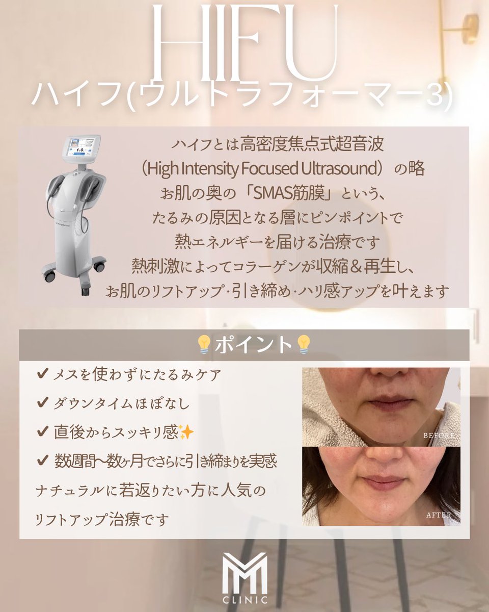 フェイスリフト超音波 🩵ハイフ（HIFU） 超音波でSMAS層を引き締め、フェイスライン・二重