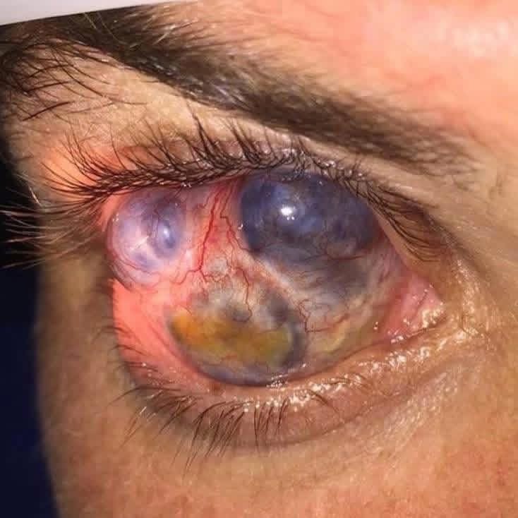 hemo_shk's tweet image. #Ophthalmology 

Clue: There’s no infection, no redness, and no inflammation.

What is the diagnosis 

#MEDHM #MedX @IhabFathiSulima