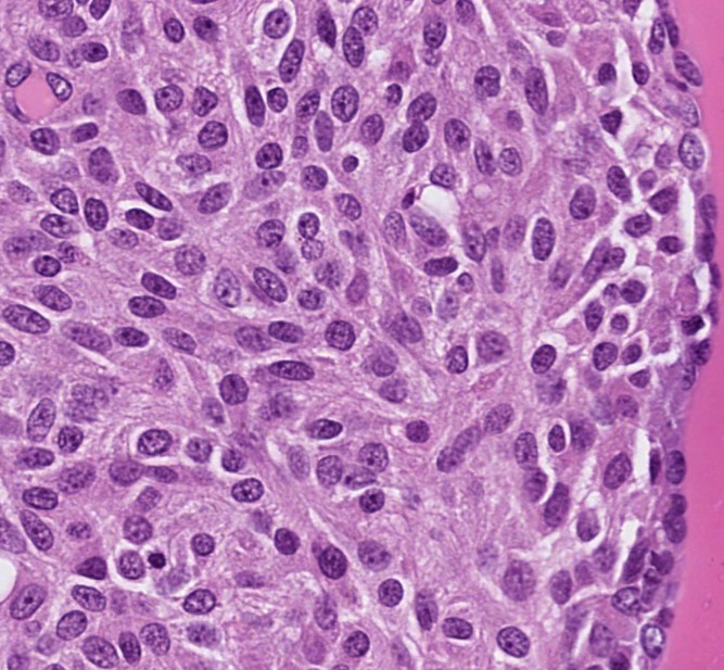 Medullary thyroid carcinoma - FNAC vs histology.

🔹 FNAC: Dyshesive, plasmocytoid cells with variable shapes &amp; long tapering processes.
🔹 Histology: Spindle-shaped cells with neuroendocrine chromatin.

Classic cytology–histology correlation!
