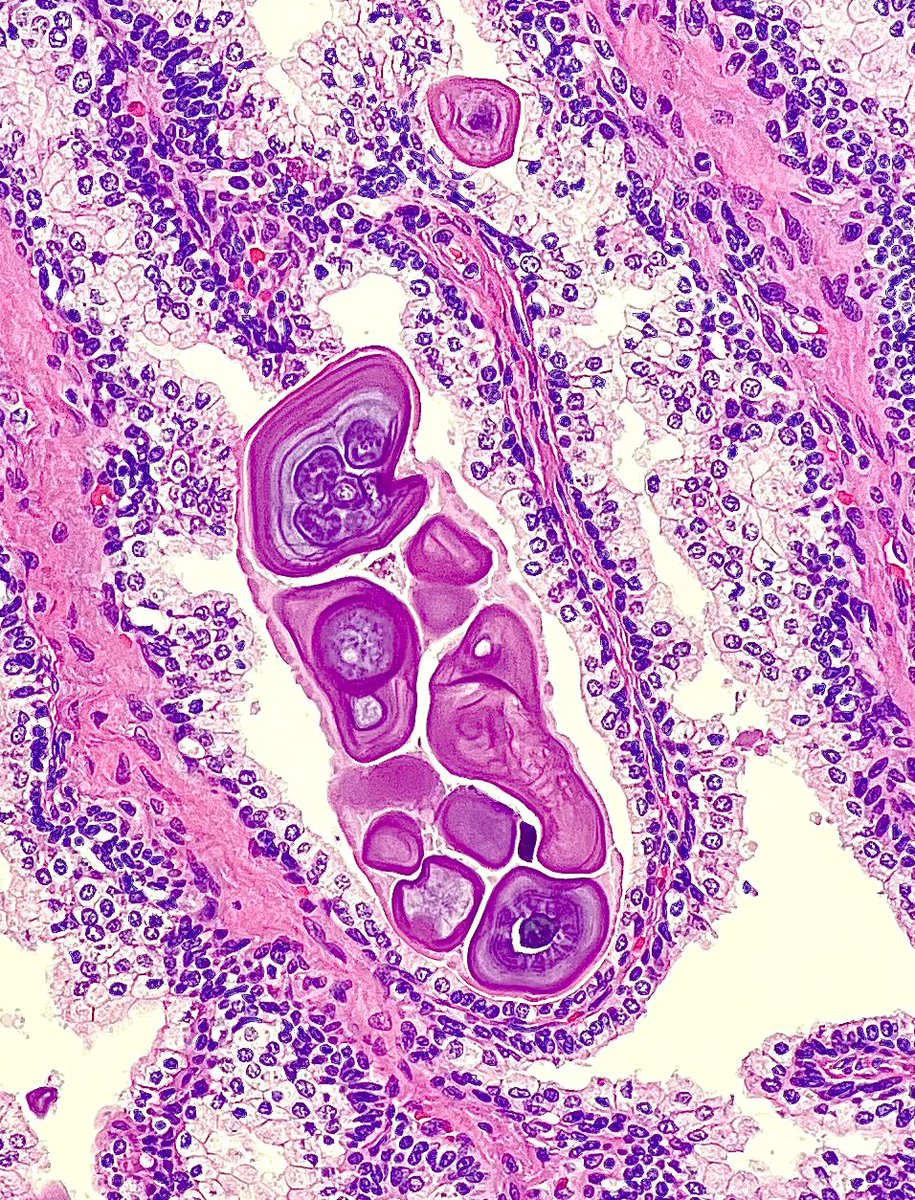 Nate_path's tweet image. Don’t just rush through those ‘uninvolved tissue’ sections, there’s still a few ‘gems’ to appreciate 💎 #PathX #gupath #prostate