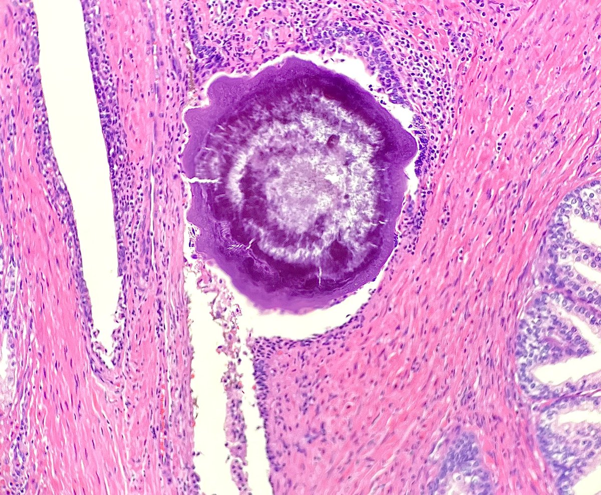 Nate_path's tweet image. Don’t just rush through those ‘uninvolved tissue’ sections, there’s still a few ‘gems’ to appreciate 💎 #PathX #gupath #prostate