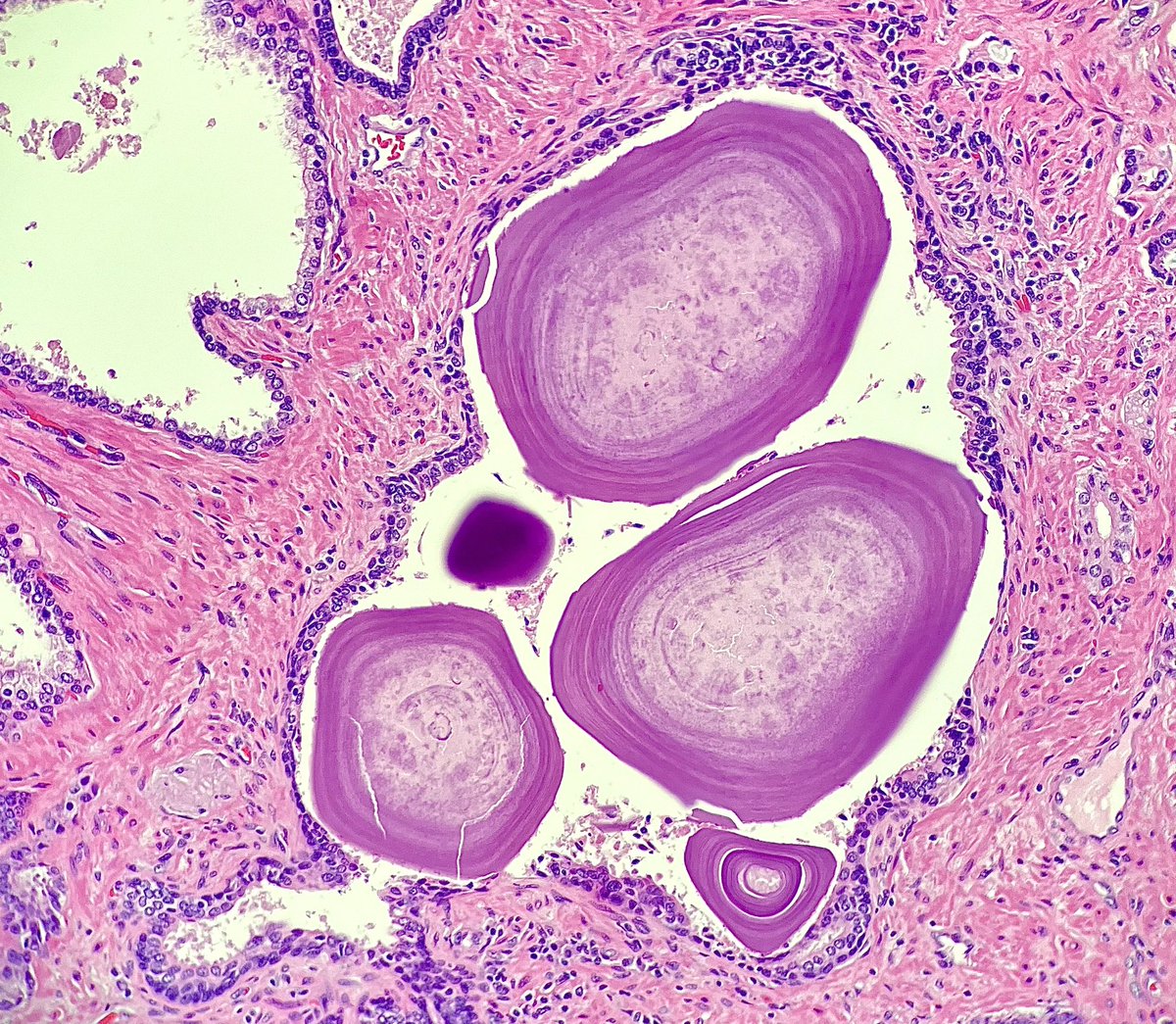 Nate_path's tweet image. Don’t just rush through those ‘uninvolved tissue’ sections, there’s still a few ‘gems’ to appreciate 💎 #PathX #gupath #prostate
