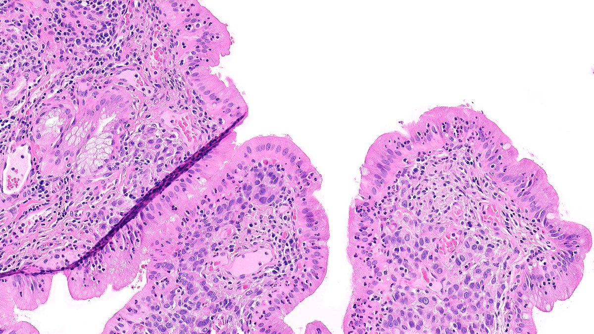 Case of Metastatic Lobular Carcinoma to Gallbladder ☄️🔬

Chronic cholecystitis on the requisition? 🤔

Those dyscohesive cells in the wall might tell a different story 😦

#PathX #PathTwitter #breastpath