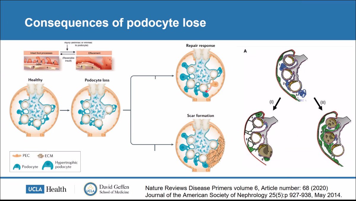 Fantastic session by the amazing <a href="/JZRenalPath/">Jonathan Zuckerman MD PhD</a> at the <a href="/GlomCon/">GlomCon</a> Glomerular Disease Fellowship Program.
⭐️👌

👇#NephX #GlomerularDisease