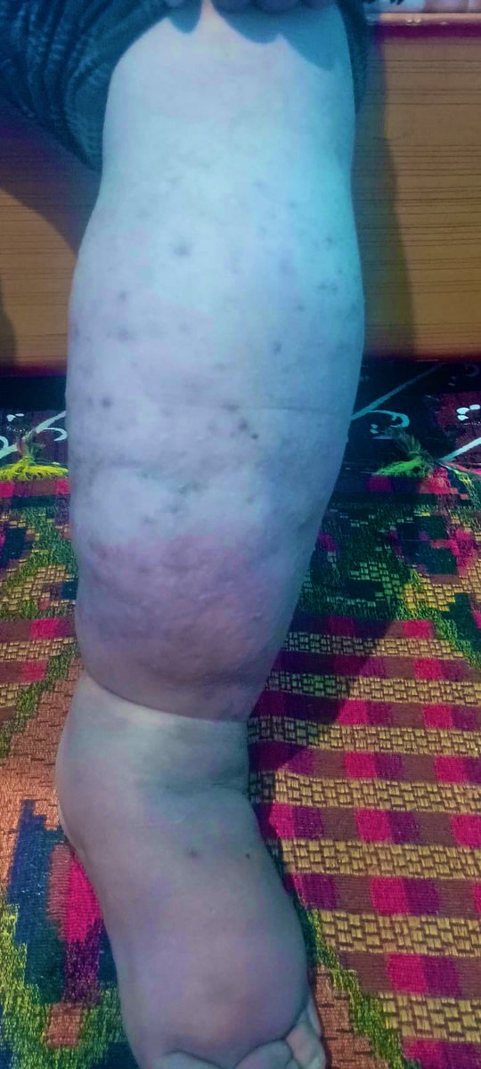 TahirPeerzada_'s tweet image. Mudassir Hassan, a street vendor from Wasserkund, Kishtwar has been bedridden for the last two years due to severe vein blockage! He was the sole breadwinner of his family but is now unable to work! His wife and two small children are struggling to survive and need urgent help…