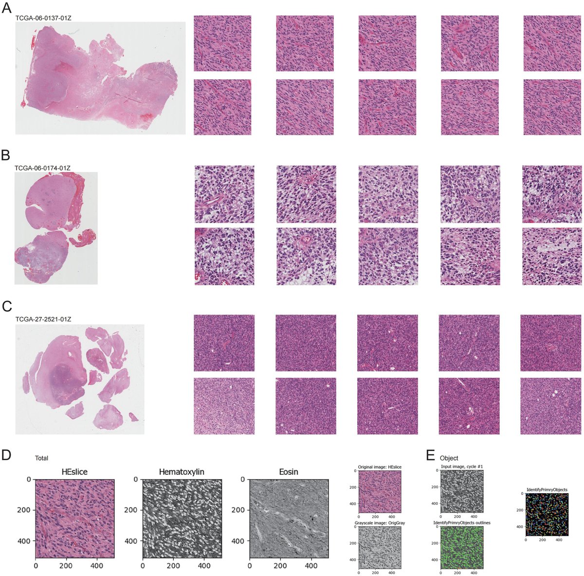 Human_Pathology's tweet image. New in #HumPathol: Integrating computational pathology and multi-transcriptomics to characterize glioblastoma heterogeneity and identify prognostic biomarkers. sciencedirect.com/science/articl… #pathology #PathTwitter #PathX #neuropath