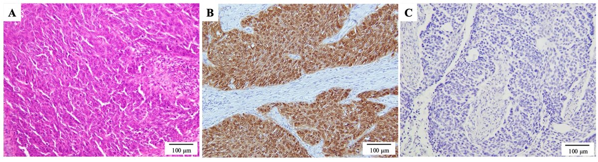 Human_Pathology's tweet image. New in #HumPathol: Prevalence and Distribution of Human Papillomavirus Type 16 in Esophageal Squamous Cell Carcinoma and Its Association with p16INK4A Expression: A Large-Scale Study in Japan. sciencedirect.com/science/articl… #pathology #PathTwitter #PathX #GIpath