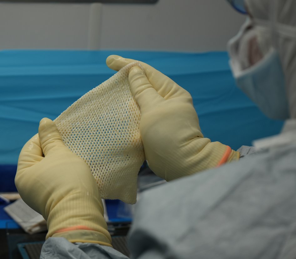 Every implantation represents a patient, a surgeon, and a mission fulfilled.

✨ 60,000+ AlloSource ADM with DermaTrue® Technology

Together — more than 60,000 times we’ve honored our mission to help patients heal.

#MissionDriven #DoMoreWithLife
brnw.ch/21wXszn