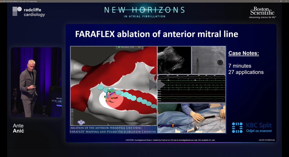 BSC_EU_Heart's tweet image. At #NHAF2025, we close the day with an expert discussion on the future of #AtrialFibrillation ablation &amp;amp; #StrokeManagement.

Dr. @AnteAnic4  shared insights on FARAFLEX™, while Profs. Peichl &amp;amp; Boveda highlighted advances shaping #PFA and #StrokePrevention.

#Epeeps #CardioX