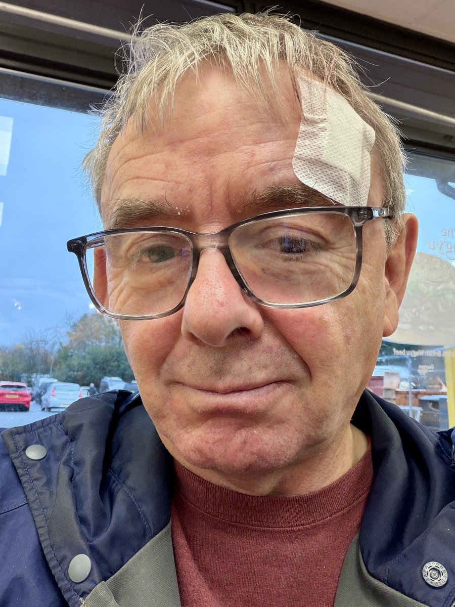 LifeAfloat's tweet image. A painless procedure but stings now. Four nasty sun damage lesions removed (head, back &amp;amp; chest). Respect the sun!