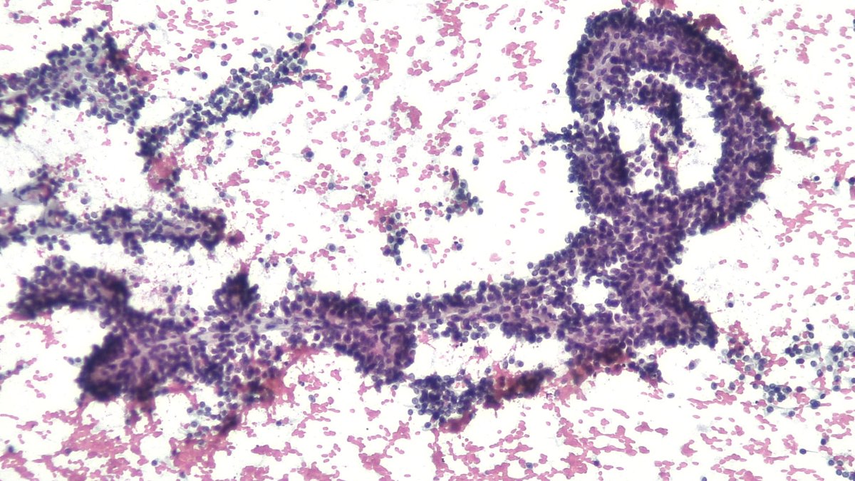 mdlozanoe's tweet image. An illustrative example of a pancreatic SPN. A picture says it all.🦎 #cytopath #SEAPJOVEN @IACytology @EfcsYoung @PapSociety @mtsiddi @CiolyRiveroC @MansoAso @RRobledano @samramed
