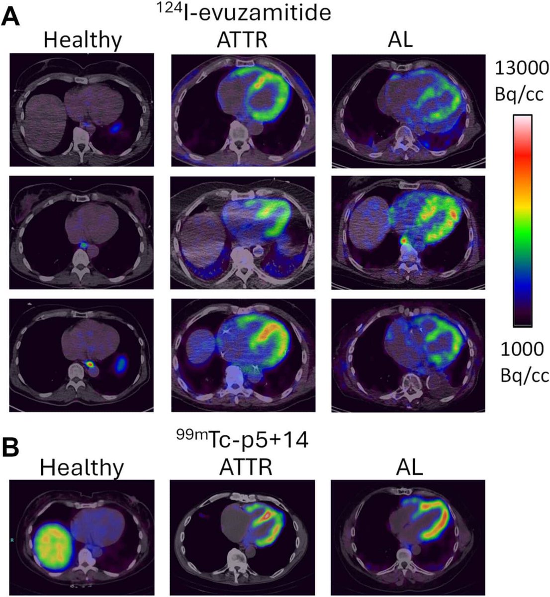 AlgarniMushref's tweet photo. Pan-amyloid tracers may be the next big leap in cardiac amyloidosis imaging 🔬❤️

At #ASNC2025, two investigational agents — ¹²⁴I-evuzamitide (PET/CT) and ⁹⁹ᵐTc-p5+14 (AT-05) — showed strong sensitivity for both ATTR & AL.

Why this matters:
• 🔍 True amyloid binding
• 🧠 Pan-amyloid detection (not just TTR)
• 📉 Potential for therapy monitoring
• 🖥️ PET quantification for organ-level amyloid load
• 🩺 Earlier diagnosis → better outcomes

FDA approval for ¹²⁴I-evuzamitide could come as early as 2027.

A new era in amyloidosis imaging may be closer than we think.

#NuclearMedicine #CardiacPET #CardiacAmyloidosis #ASNC #MolecularImaging #Radiology #ATTR #AL