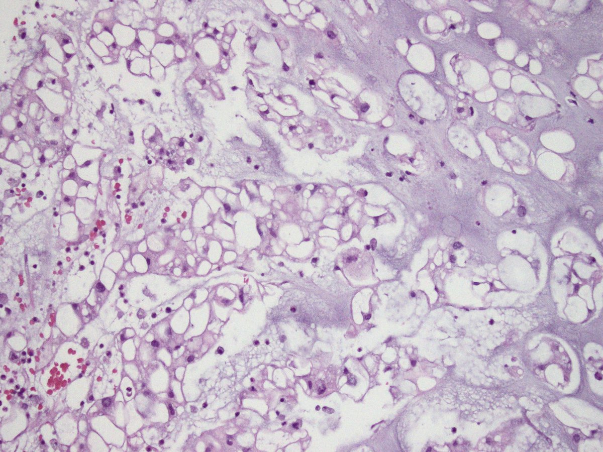 Intracranial mass in a young patient, which immunostains confirm the diagnosis?
#pedipath #neuropath #bonepath #pathology
