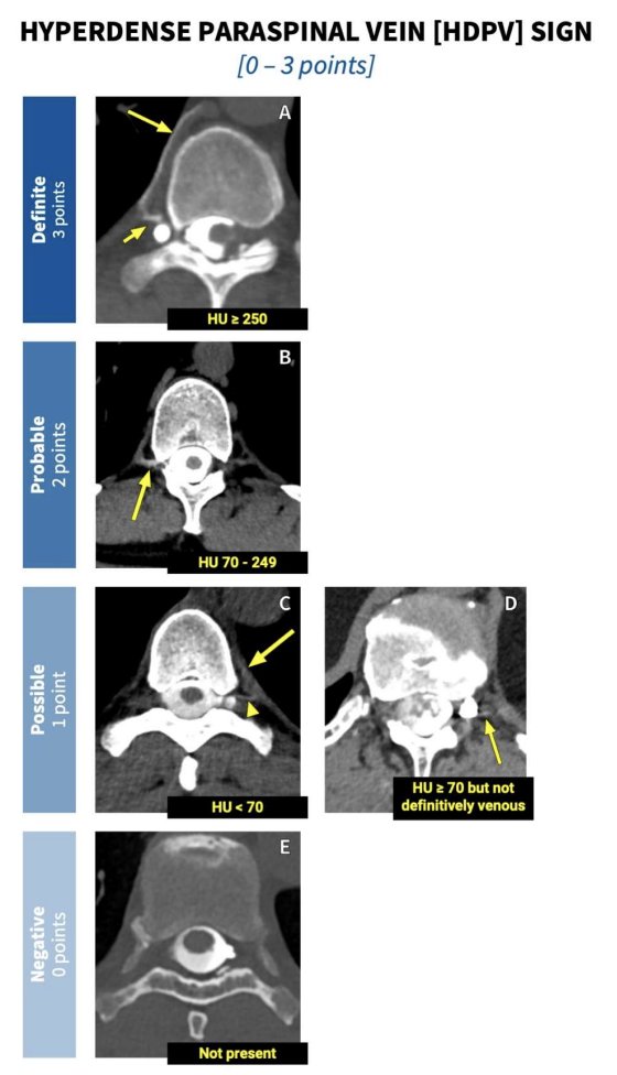 TheAJNR's tweet image. &quot;Reporting the Degree of Certainty of CSF-Venous Fistulas in Patients
with Spontaneous Intracranial Hypotension: The Duke CSF-Venous
Fistula Confidence Score&quot;

doi.org/10.3174/ajnr.A…

@TheAJNR @The_ASSR @TimAmrheinMD @PeterGKranz @DukeRadiology
