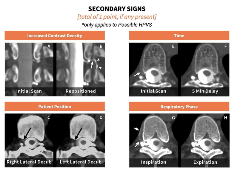 TheAJNR's tweet image. &quot;Reporting the Degree of Certainty of CSF-Venous Fistulas in Patients
with Spontaneous Intracranial Hypotension: The Duke CSF-Venous
Fistula Confidence Score&quot;

doi.org/10.3174/ajnr.A…

@TheAJNR @The_ASSR @TimAmrheinMD @PeterGKranz @DukeRadiology