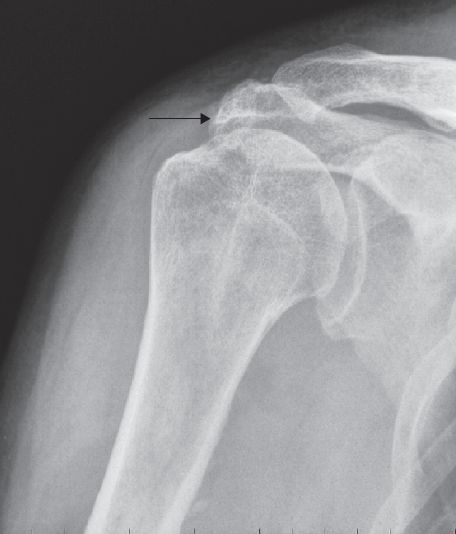A gap of less than 7 mm between the acromion (arrow) and the humeral head indicates that there is a full-thickness tear of the rotator cuff. No further imaging is needed to confirm the diagnosis. The narrower the distance, the larger the tear. (From Beggs 2004)