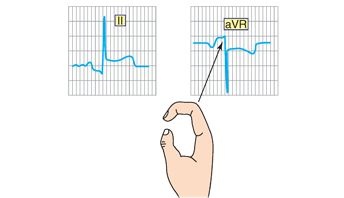 TrackYourHeart's tweet photo. 1. What is the name of the sign?
2. What condition is it clinically associated with? https://t.co/TcCK4GhtN8