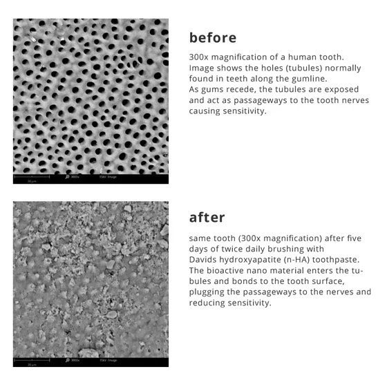 MagnusVigso's tweet image. To the ones who think it&apos;s impossible to reverse teeth density

There are 12 days apart these pictures

Notice the greyish loss of enamel in the before which is being restored by the nanohydroxyapatite.

The second picture is a visual dential tubules
(natural pathway present in…