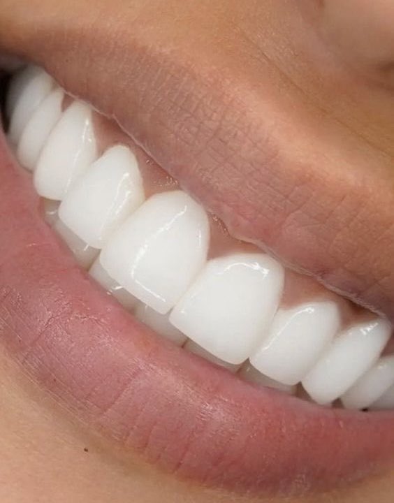 MagnusVigso's tweet image. To the ones who think it&apos;s impossible to reverse teeth density

There are 12 days apart these pictures

Notice the greyish loss of enamel in the before which is being restored by the nanohydroxyapatite.

The second picture is a visual dential tubules
(natural pathway present in…